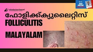 Folliculitis Malayalam sycosis barbaebarbers itchscalp folliculitis malayalam dr sujith karimbil [upl. by Fae470]