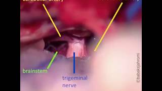 Trigeminal Neuralgia [upl. by Niltyak]