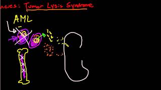 Oncologic Emergencies Tumor Lysis Syndrome [upl. by Adnihc]