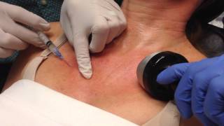 Sculptra for the Decollete using blunt cannulas Dr Steven Weiner Destin [upl. by Herta]