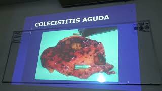 Clase Colecistitis Aguda [upl. by Zane]