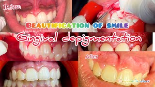 Beautification of smileGingival Depigmentation using scalpeldepigmentation [upl. by Rubetta]