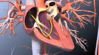 Cateterismo de la arteria pulmonar VIDEOS IN CLINICAL MEDICINE NEJM [upl. by Hazelton]