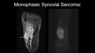 Monophasic Synovial Sarcoma [upl. by Huberty]