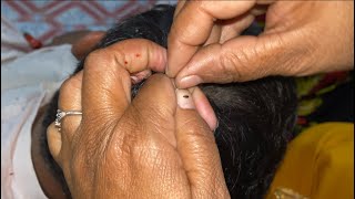 ASMR Kuto lices Wife removed husband hair lice 😱 satisfies ￼lice and nits picking with hands [upl. by Nevile]