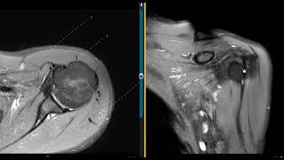 Shoulder pain in 26 year old No trauma [upl. by Jobi936]