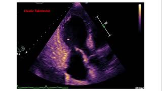 Takotsubo Cardiomyopathy broken heart syndrome [upl. by Ainit]