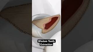 Wisdom Tooth Extraction 3D Animation [upl. by Adnamor909]