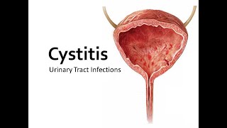 Cystitis lecture [upl. by Griffin]