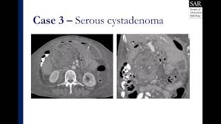 Solid and cystic pancreatic lesion [upl. by Hoenack]