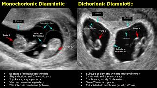 Fetal Twins Ultrasound Normal Vs Abnormal  MonochorionicDichorionicDiamnioticMonoamniotic USG [upl. by Kola]