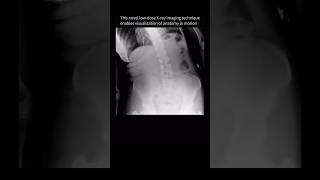 Spine movement seen for the FIRSTTIME with dynamic XRay backpain anatomy [upl. by Nnylsia556]