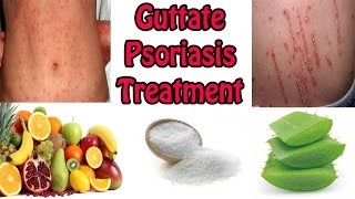 Guttate Psoriasis Treatment  Best Cure For Guttate Psoriasis With Natural Home Remedies [upl. by Vincenty]