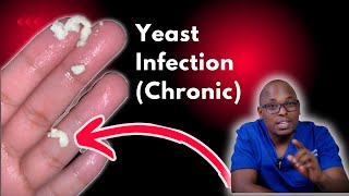 Chronic Yeast Infections  Recurrent yeast Infections  Causes signs and symptoms Treatment [upl. by Annoj937]