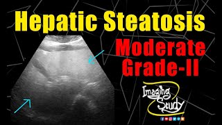 Moderate Hepatic Steatosis  GradeII Fatty Liver  Ultrasound  Case 222 [upl. by Alyled]