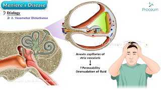 Menieres Disease 🌀  ENT Lectures [upl. by Namia]