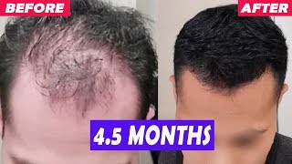 MOST INSANE Finasteride Hair Regrowth You Will See 4 Month Result [upl. by Werna]