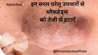 Complete Blackheads Remove Remove Blackheads FAST With These Simple Home Remedies blackheads [upl. by Irik455]