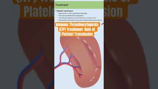 Immune Thrombocytopenia ITP Treatment Role of Platelet Transfusion immunethrombocytopenia itp [upl. by Kev]