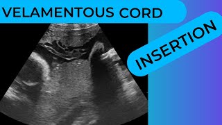 Velamentous Cord Insertion on Ultrasound Scan [upl. by Yessej715]