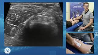 Sonographic assessment of the posterior knee for POCUS clinicians [upl. by Titos]