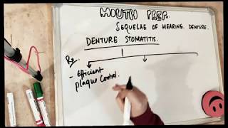 denture stomatitis sequelae of wearing complete denture 2 [upl. by Ocsinarf]