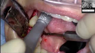 PRAMA NECK 28 mm LOWER MOLAR SURGERY STEP BY STEP [upl. by Homere]