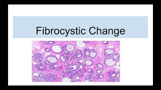 Fibrocystic Disease of Breast [upl. by Eniagrom]