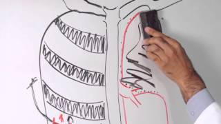 Lobectomy of Lung  Minimally Invasive Approach to Lung Cancer Surgery [upl. by Leavelle]