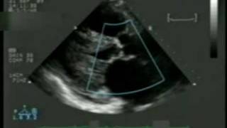 2D Echocardiogram with Doppler [upl. by Euqnomod]