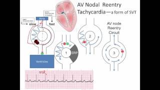 ECG understanding supraventricular tachycardia or SVT [upl. by Brandy]