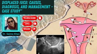 Displaced IUCD Causes Diagnosis and Management – Case Study healthytips DrSaimakhan [upl. by Naehs935]