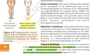 Turner Syndrome 45XO [upl. by Oinotla]