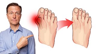 How to Fix Bunions in 3 Steps [upl. by Maretz]