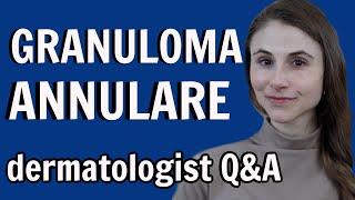 Granuloma annulare treatments and causes dermatologist Dr Dray [upl. by Carlye]