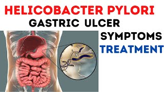 Helicobacter Pylori infection pathogenesis treatment [upl. by Shanna]