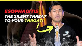 Esophagitis The Silent Threat to Your Throat [upl. by Bel]