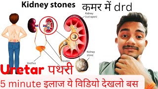 Kidney stonesUreter stone 🪨Cause Symptoms Treatment only in 5 minute [upl. by Demodena243]