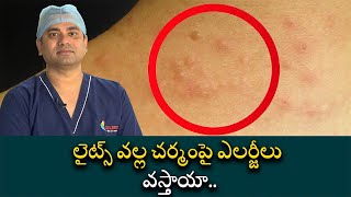 Polymorhous Light Eruption Symptoms and Causes  లైట్స్ వల్ల చర్మంపై ఎలర్జీలు వస్తాయా [upl. by Novelia150]