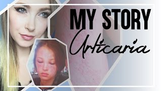 My Story Urticaria Chronic Idiopathic Hives [upl. by Ahseekal]