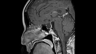 Endocrinology and DM Course Day 10 Empty Sella Syndrome Pituitary Hormones Deficiency and etc [upl. by Oratnek154]