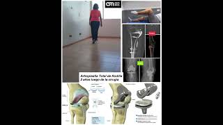 Protesis Total de Rodilla Dr Maizo [upl. by Aisset]