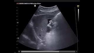 POCUS in Clinics 7 an important and rare cause of massive ascites you need to know [upl. by Aerdnod738]