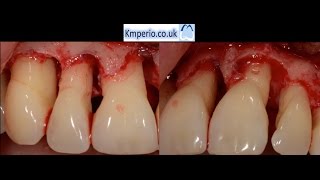 Periodontal Surgery with Regeneration for Upper Teeth [upl. by Salba]