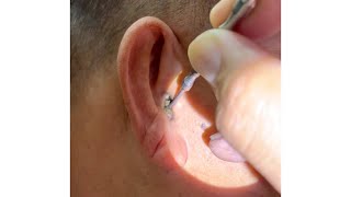 Removing Grandpas 70 Year Old Hard Earwax [upl. by Nojram]