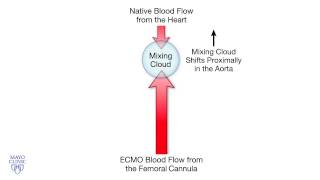 Femoral Cannulation and VenoArterial ECMO  Mayo Clinic [upl. by Emili]