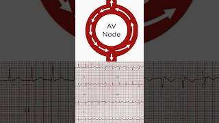 AVNRT ECG [upl. by Hultin163]