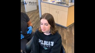 Braces Removal Time lapse  Braces and Invisalign  Omaha NE [upl. by Niko]