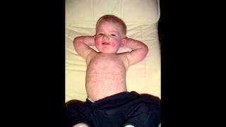 quotSlapped Cheeksquot erythema infectionsumfifth disease parvovirus B19 [upl. by Ahseinat309]