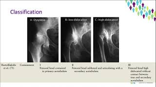 OrthoFracs  Adult Hip Dysplasia by Dr Karen Bourns [upl. by Cynthie560]